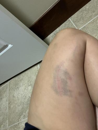 Denalis-leg-bruises