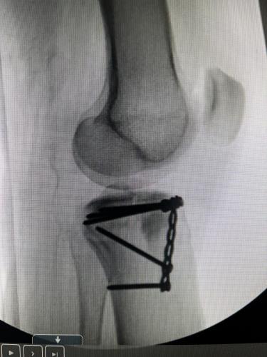 Zoeys-leg-after-surgery