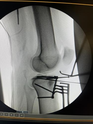 Zoeys-leg-with-retractors